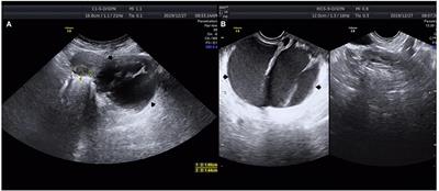 Case Report: Giant Pelvic Cystic Appearance—An Unusual Feature of Uterine Cervical Adenocarcinoma